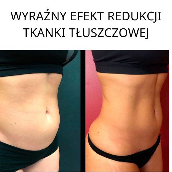 HIFU Płaski Brzuch Warszawa