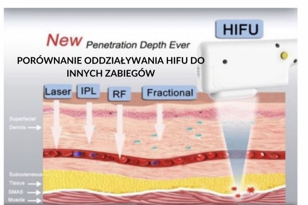 HIFU Warszawa Centrum 