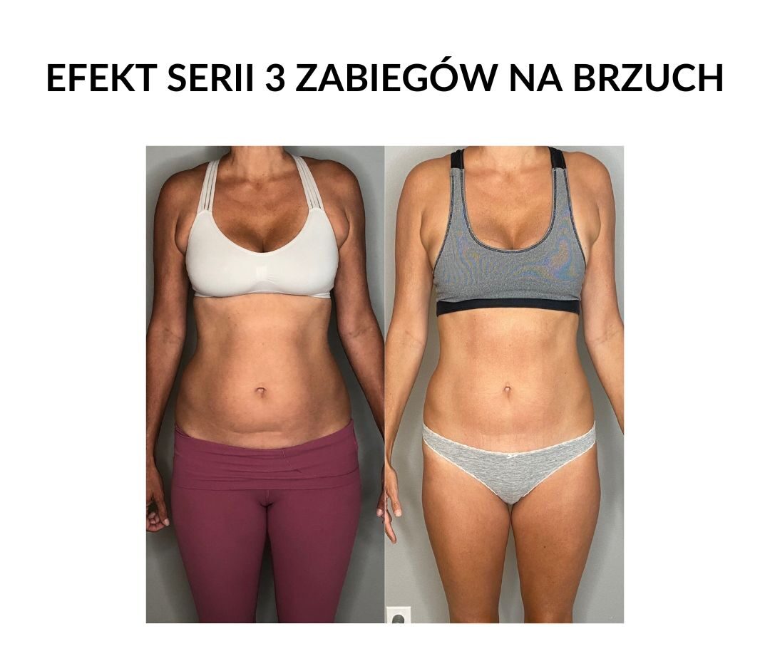 Jak uzyskać zgrabny i płaski brzuch po ciąży dzięki RF Mikroigłowej?