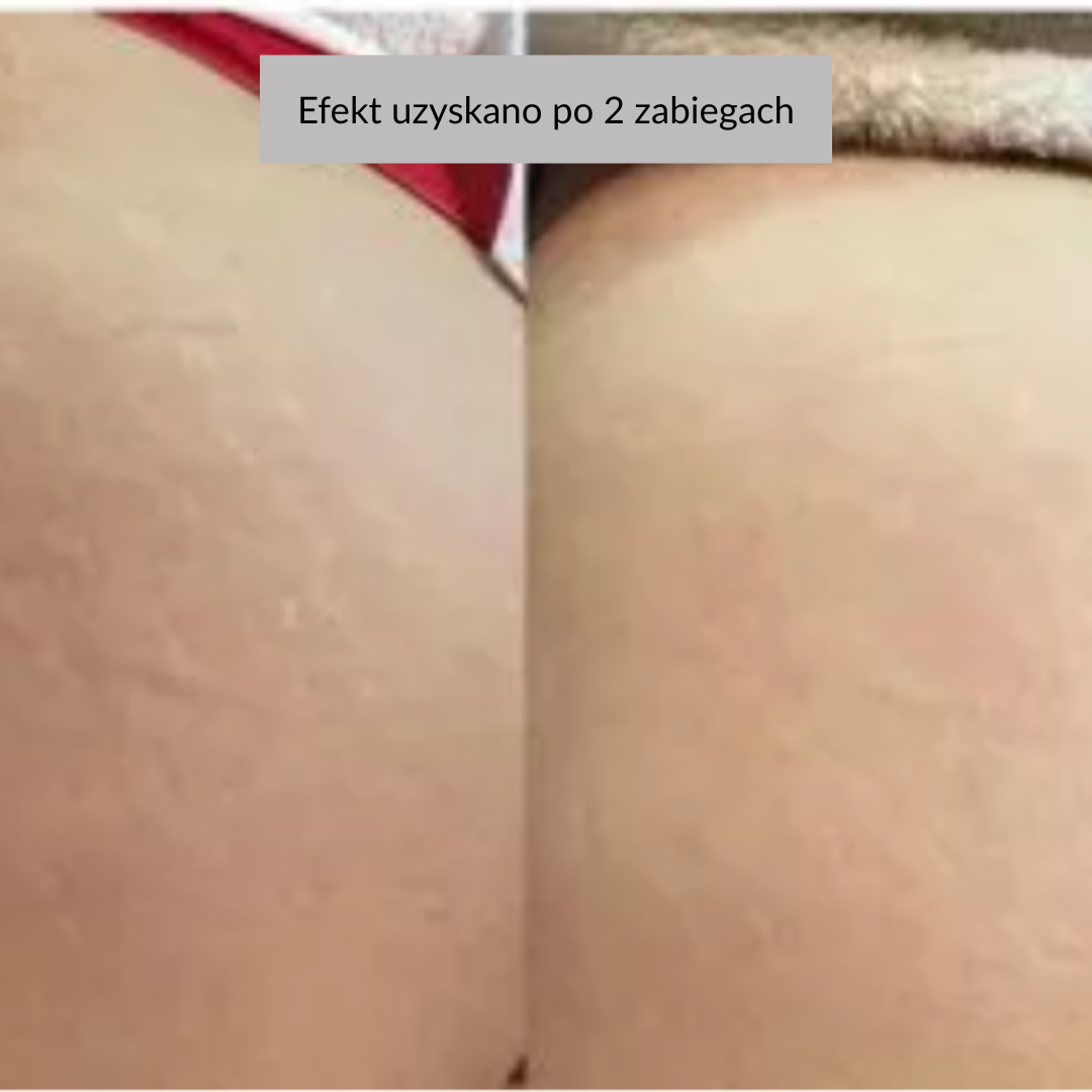 efekty zabiegu dermation na rozstępy