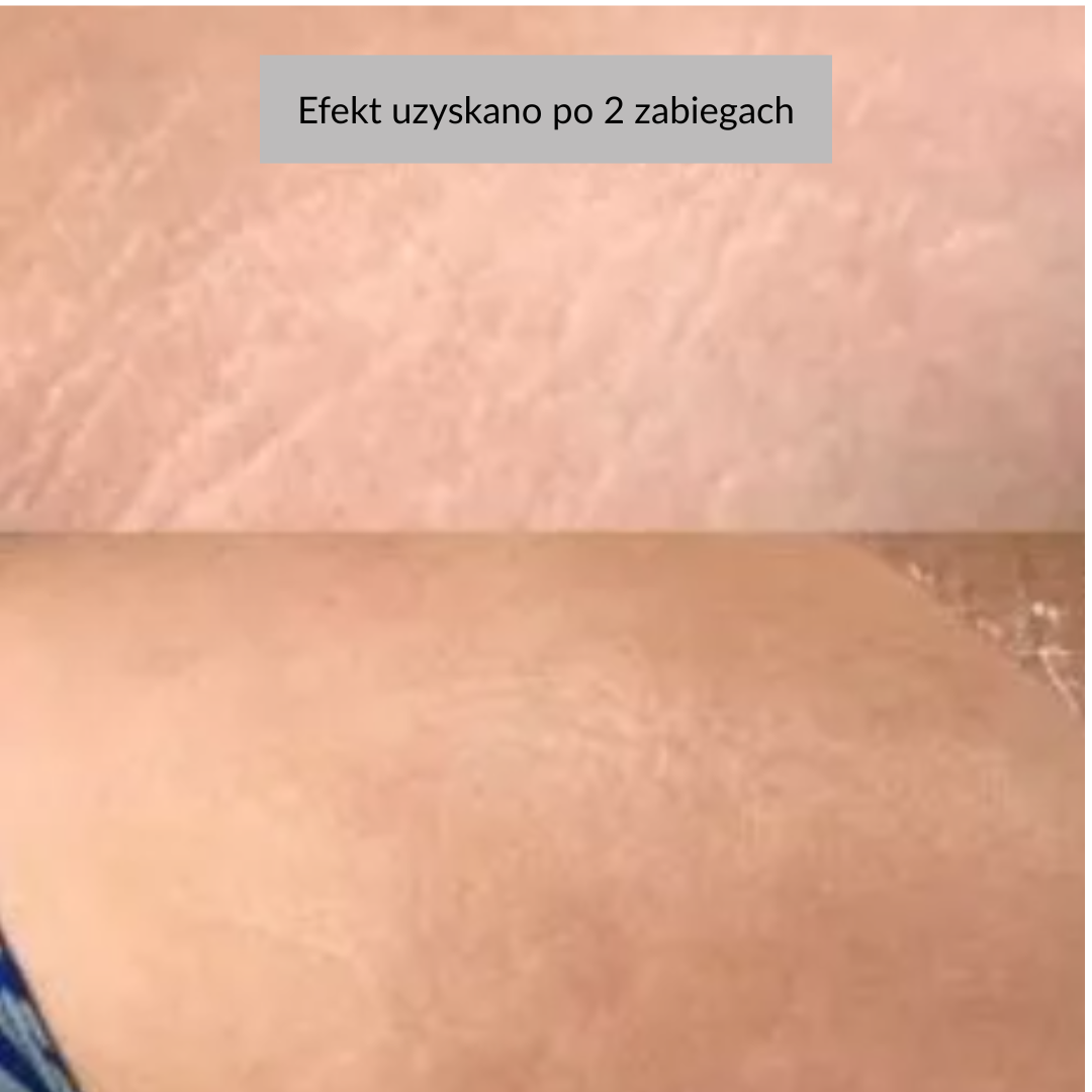 efekty zabiegu dermation na rozstępy