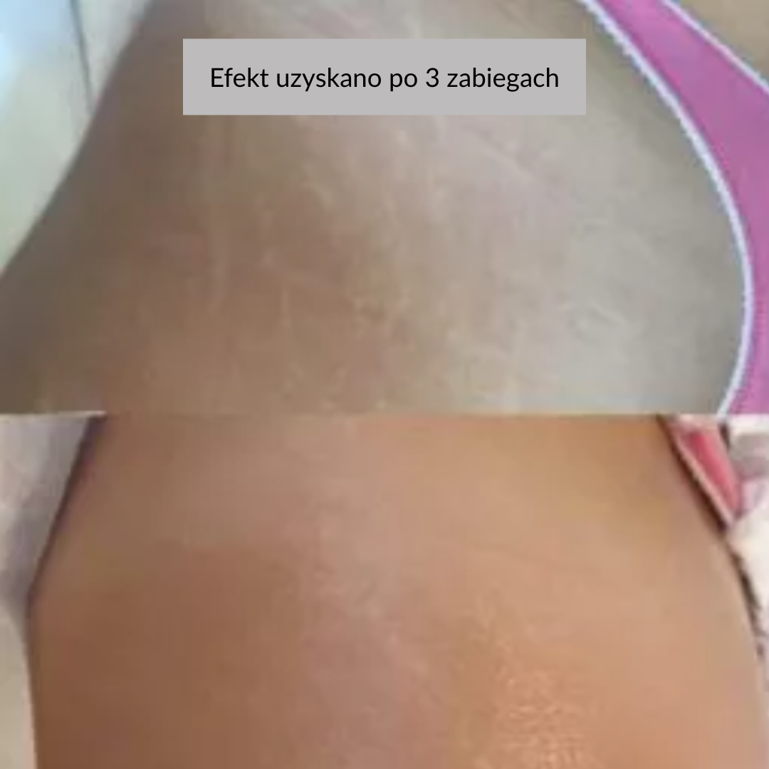 efekty zabiegu dermation na rozstępy